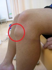 knee pain in children