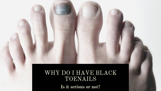 Why Do I have Black Toenails and Is It Serious? - Well Heeled Podiatry
