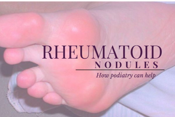 Rheumatoid Nodules