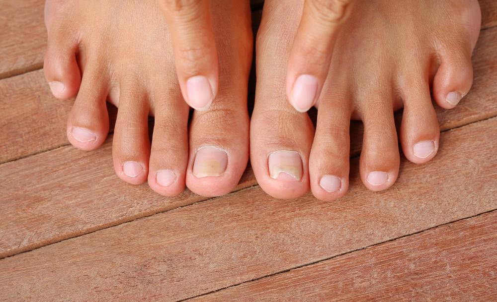 Fungal Nails & Skin Treatment - Well Heeled Podiatry Melbourne