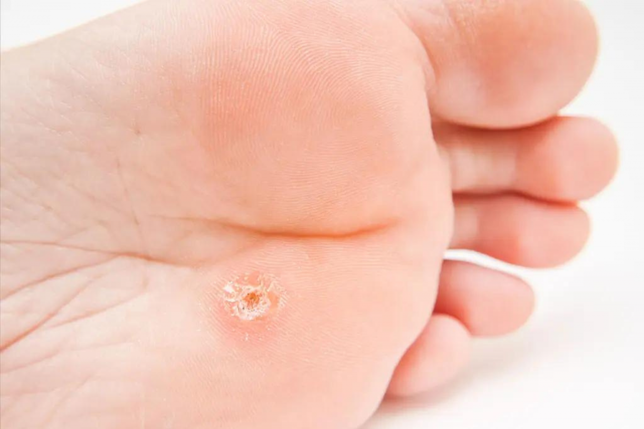 Treatment For Warts On Feet Well Heeled Podiatry Melbourne